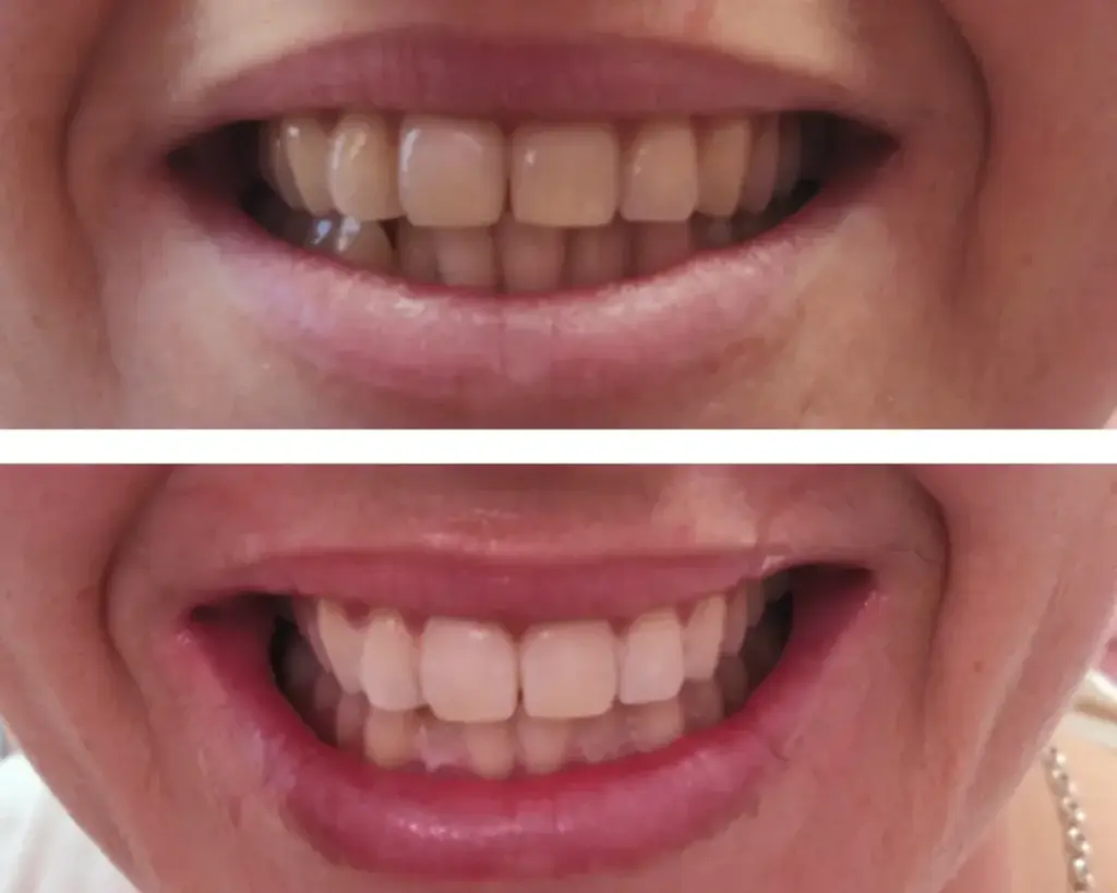 Teeth Whitening 1