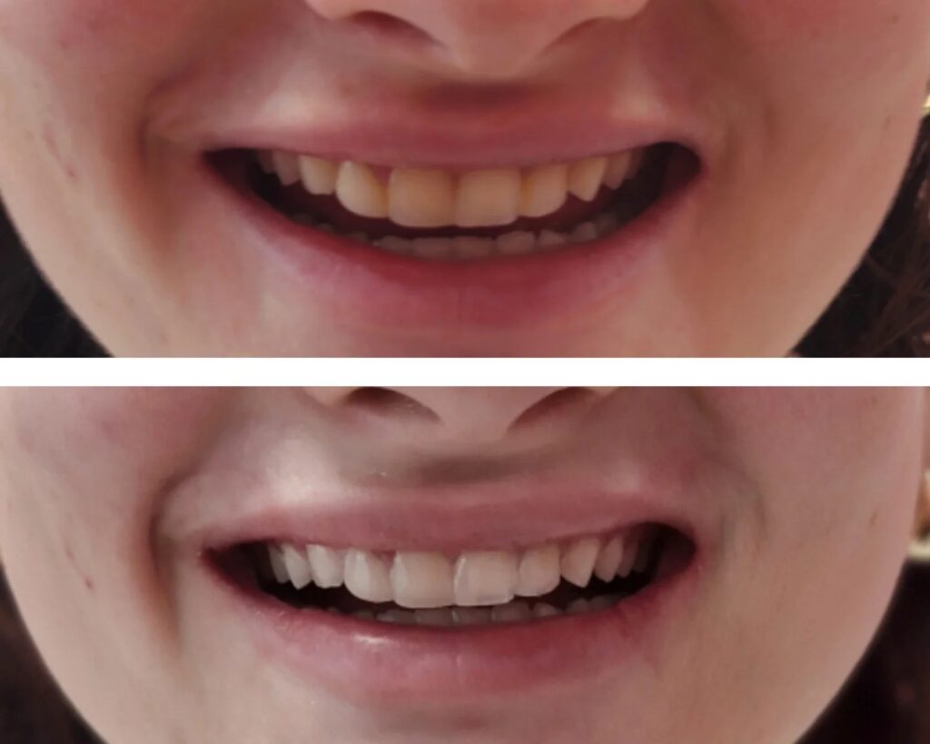 Teeth Whitening 3